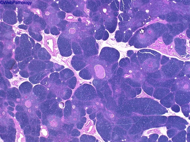 thymic hyperplasia vs thymoma pathology