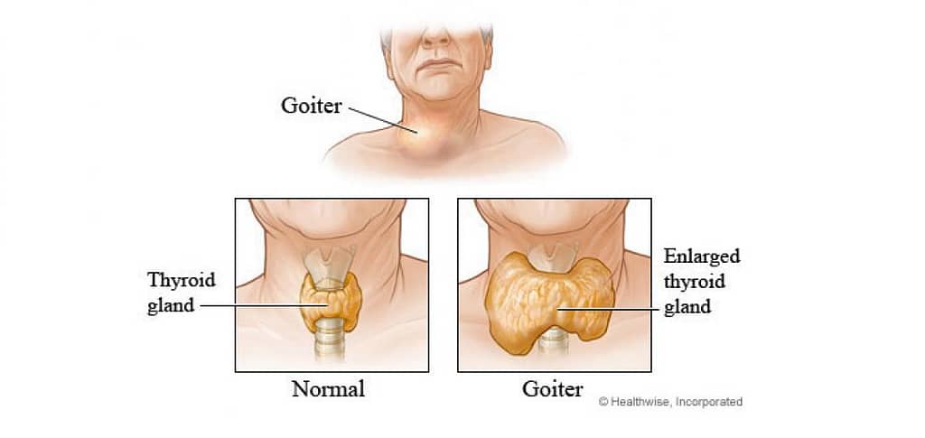 thyroid gland goiter treatment