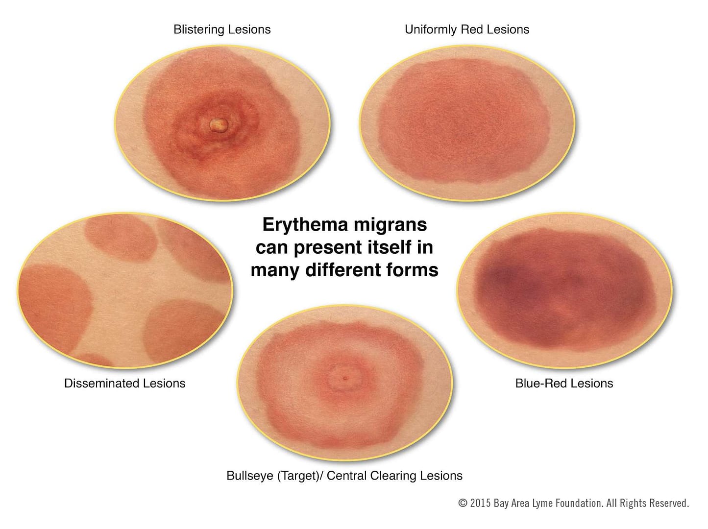  lyme disease symptoms rash itchy