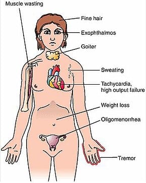 Symptoms of Graves’ Disease