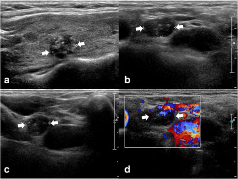 papillary thyroid cancer recurrence after total thyroidectomy