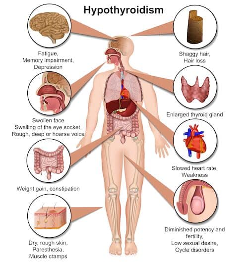 hypothyroidism symptoms and signs