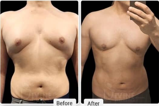 type 1 gynecomastia treatment without surgery