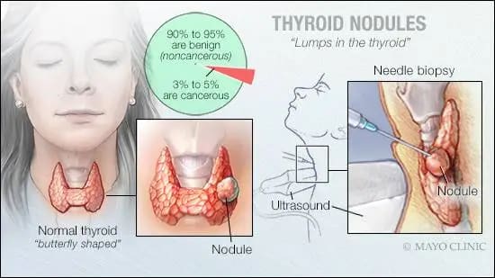 woman-thyroid-nodules-symptoms-thyroidwellnessguide