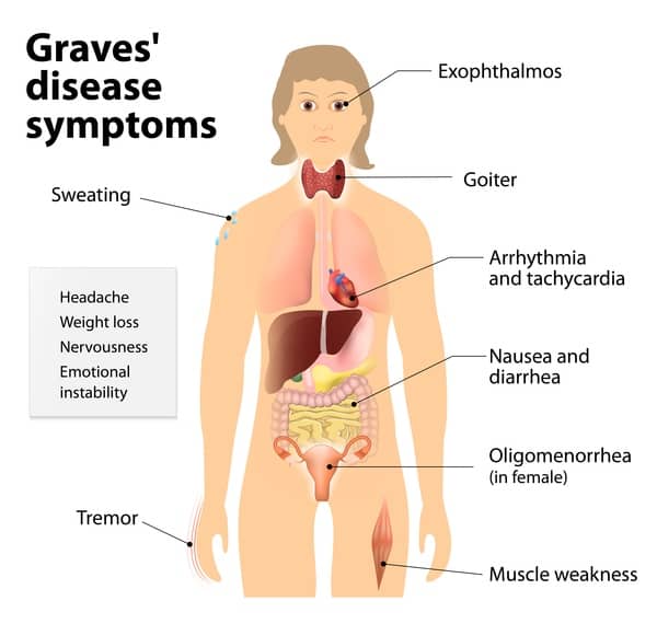 What are the key characteristics of Graves' disease?