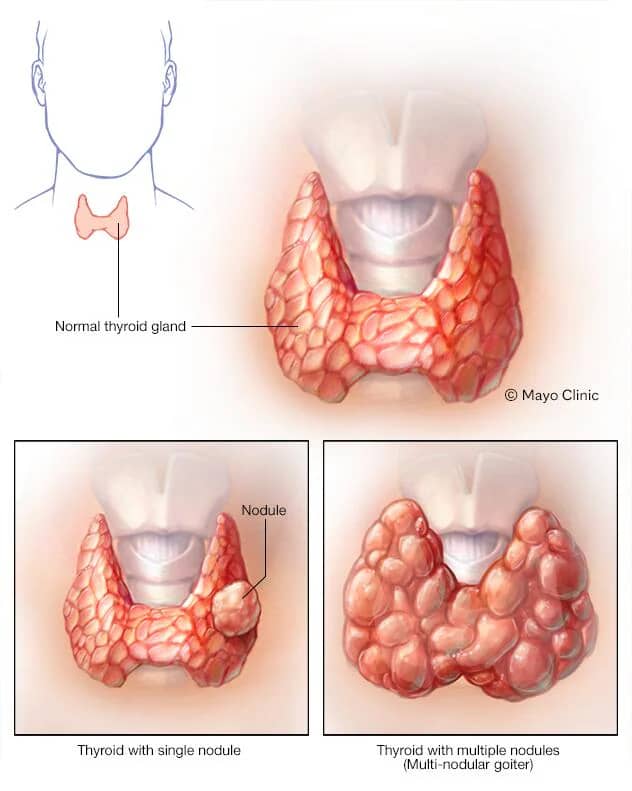 Symptoms of Thyroid Lump in Throat