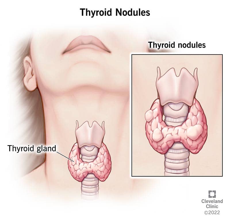 thyroid lump in throat symptoms