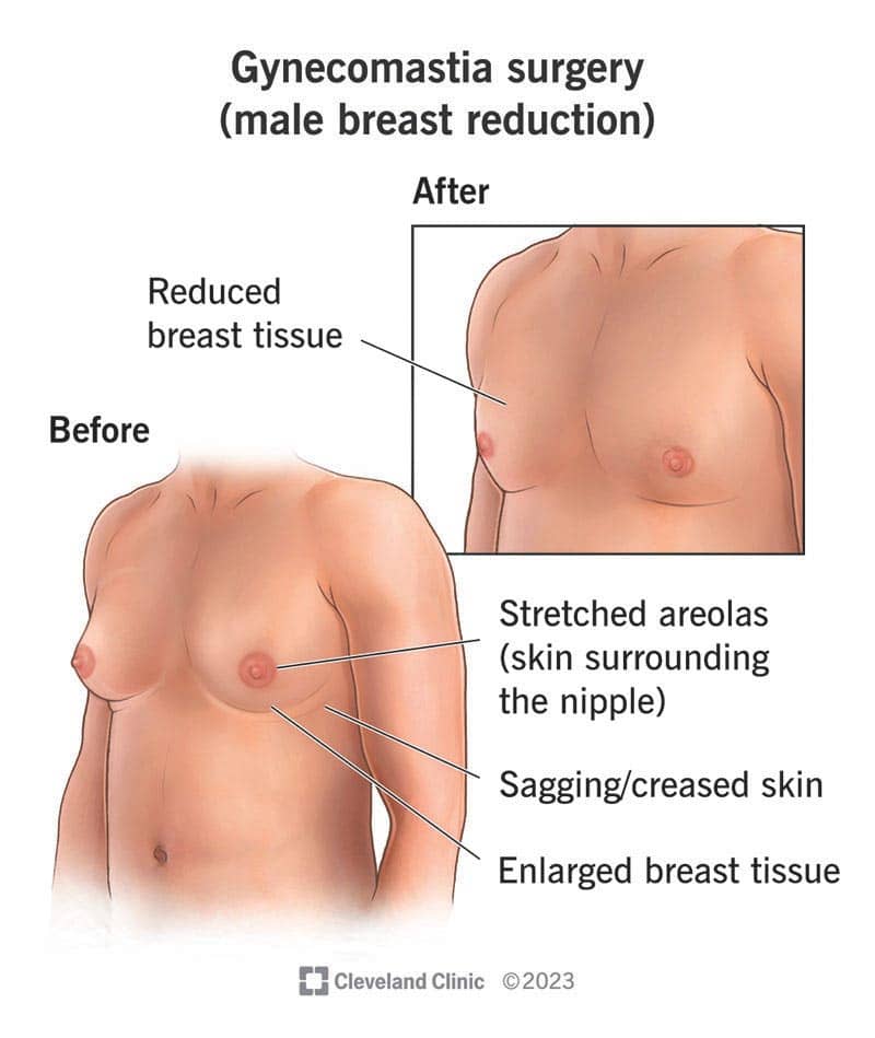 Are there any potential side effects or risks associated with the non-surgical treatments for Type 1 gynecomastia?