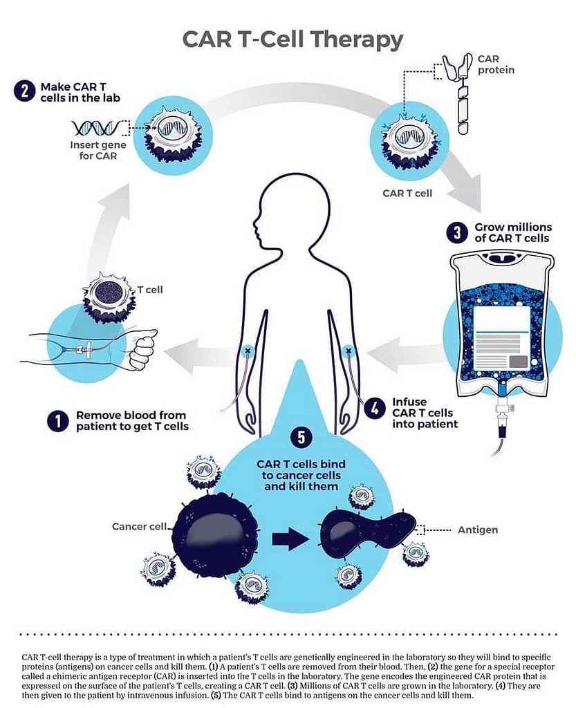 What Is CAR T-Cell Therapy?